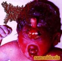Viscera Infest (Jpn) - Sarcoidosis - CD
