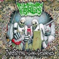 Pulmonary Fibrosis (Fra) - Interstitial Lung Diseases - CD